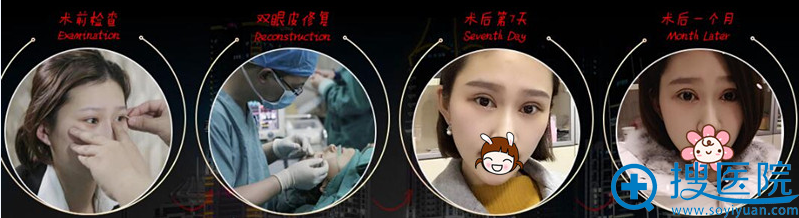 双眼皮前后对比图 双眼皮前后对比图