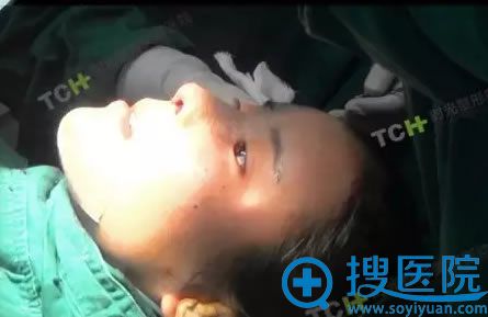 重庆时光整形综合鼻修复术后效果 重庆时光整形综合鼻修复术后效果