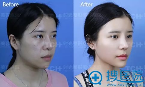 重庆时光鼻综合修复前后对比照 重庆时光鼻综合修复前后对比照