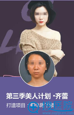 假体隆下颌 假体隆下颌