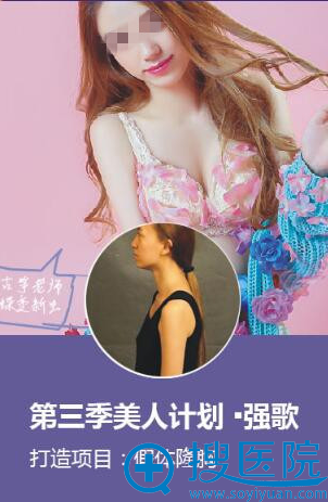假体隆胸 假体隆胸