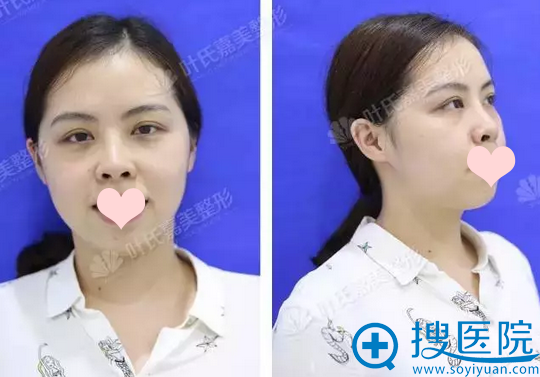 桂林叶氏嘉美整形医院朝天鼻整形案例 隆鼻后的她桃花朵朵开