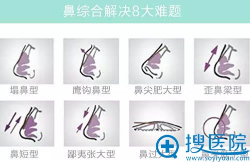 适合做鼻综合整形的8类人群 适合做鼻综合整形的8类人群