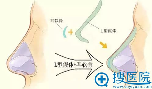 鼻综合整形示意图 鼻综合整形示意图