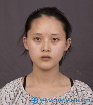 上海华美管果医生精雕双眼皮提肌案例 双眼皮+开眼角6800元
