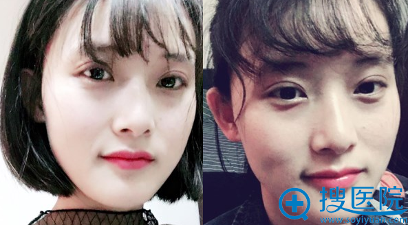 双眼皮术后25天恢复情况 双眼皮术后25天恢复情况