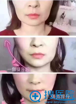 【案例】深圳非凡线雕+玻尿酸强强联合拯救干瘪又塌陷的大饼脸