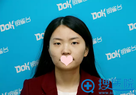双眼皮术前照片 双眼皮术前照片