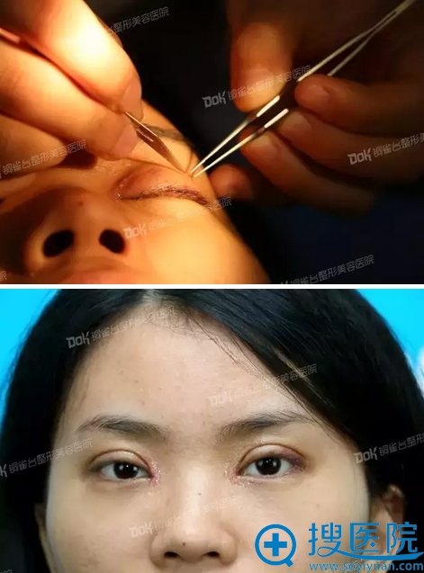 双眼皮7天拆线效果 双眼皮7天拆线效果