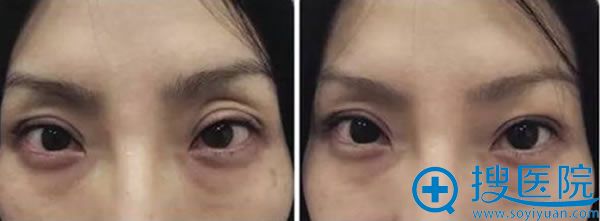 自体脂肪填充解决眼部凹陷问题 自体脂肪填充解决眼部凹陷问题