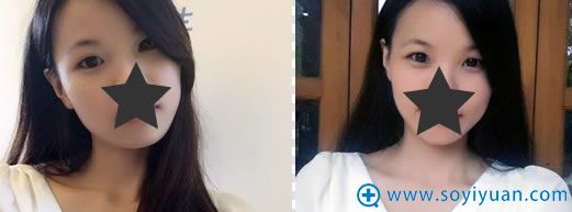 在广州壹加壹整形医院做双眼皮术前照 在广州壹加壹整形医院做双眼皮术前照