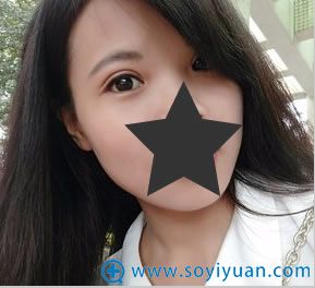 项美莲做双眼皮术后第7天效果图 项美莲做双眼皮术后第7天效果图