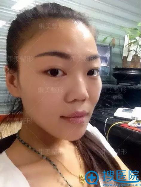 两年前隆鼻失败的我找郑州集美陈曦成功做了自体软骨鼻修复手术