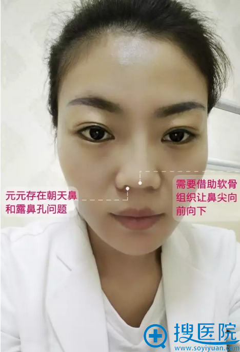隆鼻失败修复方案制定 隆鼻失败修复方案制定