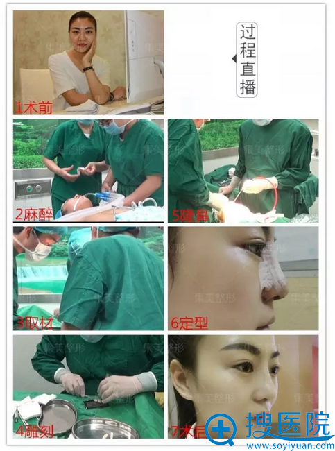 自体肋软骨隆鼻全过程 自体肋软骨隆鼻全过程