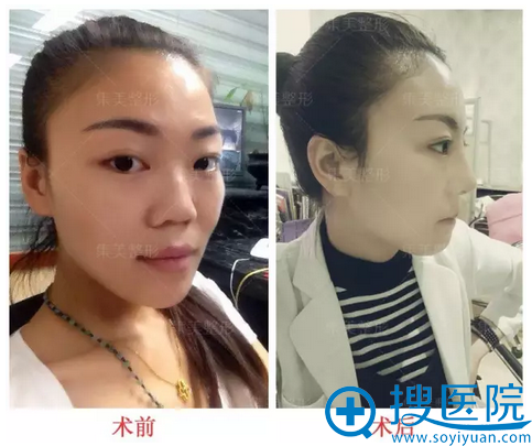 鼻修复术前术后对比图 鼻修复术前术后对比图