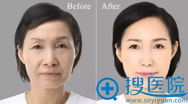 徐舰博士面部除皱前后对比案例 徐舰博士面部除皱前后对比案例