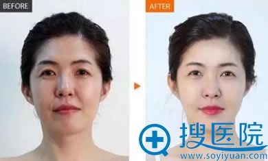 微整形医生徐舰紧致肌肤前后对比效果 微整形医生徐舰紧致肌肤前后对比效果