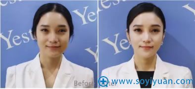 徐舰博士瘦脸案例图 徐舰博士瘦脸案例图