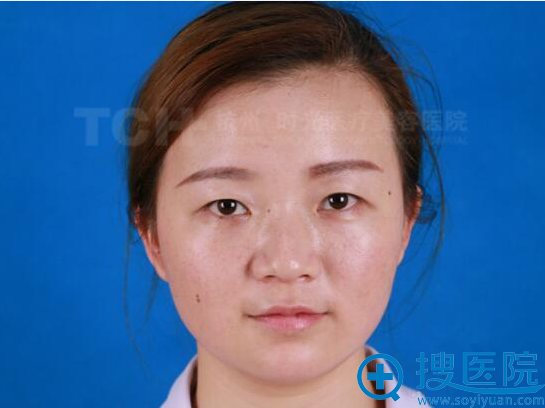 杭州时光整形真人案例 玻尿酸隆鼻和丰下巴后天天被人约!