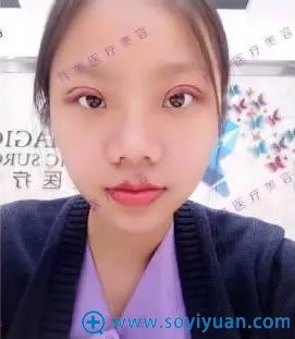 珠海科美做双眼皮术后天照片 珠海科美做双眼皮术后天照片