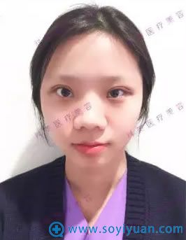 珠海科美美容医院双眼皮术后第5天恢复效果 珠海科美美容医院双眼皮术后第5天恢复效果