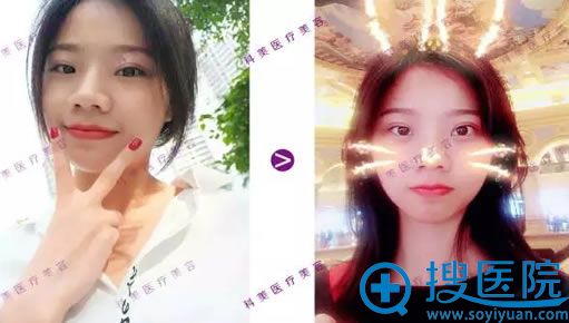 珠海科美切开双眼皮案例图 珠海科美切开双眼皮案例图