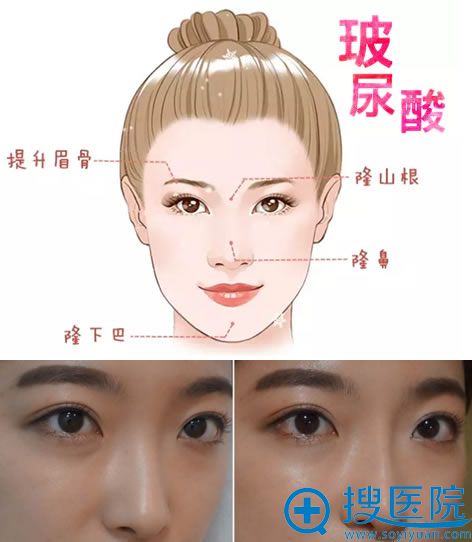 大分子玻尿酸隆鼻效果图 大分子玻尿酸隆鼻效果图