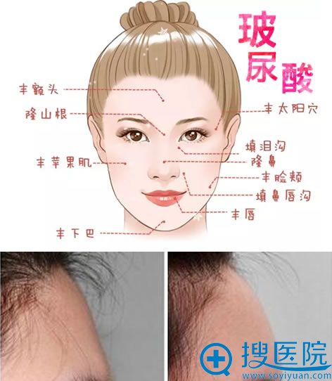 中分子玻尿酸丰额头效果展示 中分子玻尿酸丰额头效果展示