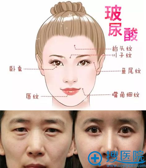 小分子玻尿酸除皱案例图 小分子玻尿酸除皱案例图