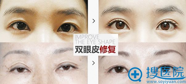 北京瀛美整形医院双眼皮修复案例 北京瀛美整形医院双眼皮修复案例