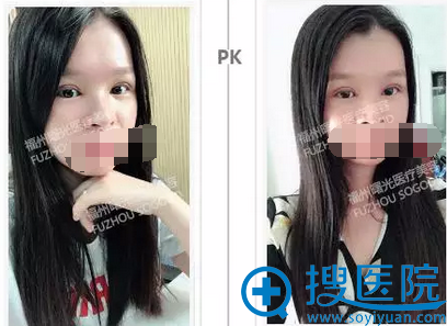 <!--<i data=20240710 data-id=12204></i>-->张莎莎双眼皮案例术后恢复照 <!--<i data=20240710 data-id=12204></i>-->张莎莎双眼皮案例术后恢复照