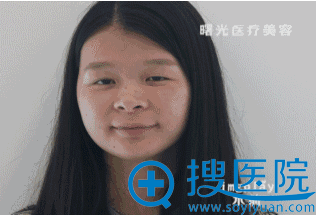 <!--<i data=20240710 data-id=12204></i>-->张莎莎双眼皮术前照 <!--<i data=20240710 data-id=12204></i>-->张莎莎双眼皮术前照