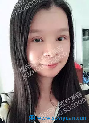 <!--<i data=20240710 data-id=12204></i>-->张莎莎小清新双眼皮术后第4天 <!--<i data=20240710 data-id=12204></i>-->张莎莎小清新双眼皮术后第4天