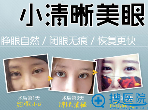 <!--<i data=20240710 data-id=12204></i>-->小清新美眼优势 <!--<i data=20240710 data-id=12204></i>-->小清新美眼优势
