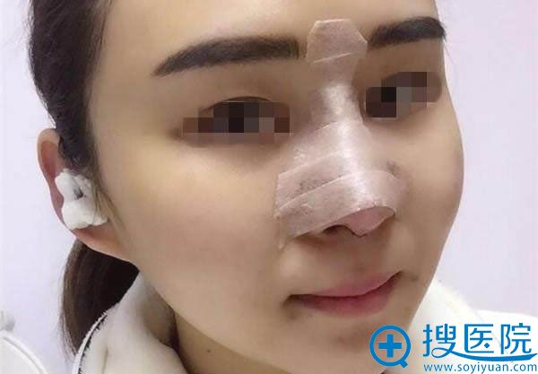 膨体隆鼻失败修复手术第1天照片 膨体隆鼻失败修复手术第1天照片