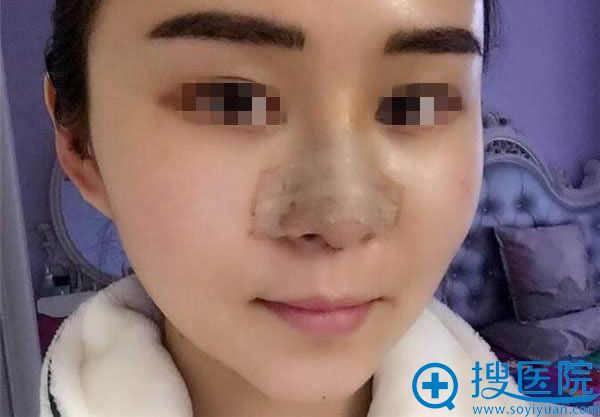 鼻综合修复手术5天的图片 鼻综合修复手术5天的图片