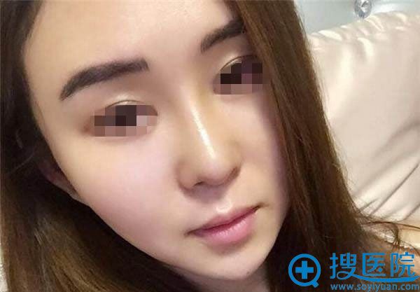 鼻修复手术第6天拆线图片 鼻修复手术第6天拆线图片