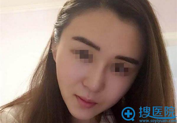 下巴吸脂手术第10天的图片 下巴吸脂手术第10天的图片