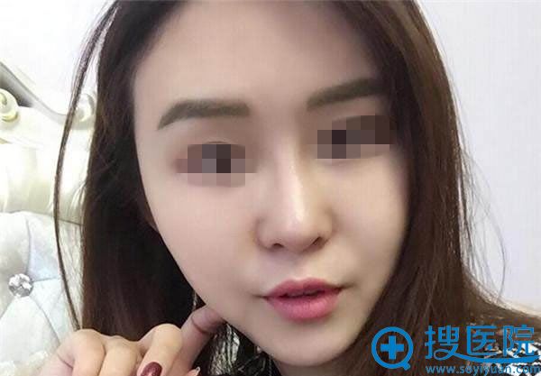 鼻综合修复和下巴吸脂1个月照片 鼻综合修复和下巴吸脂1个月照片