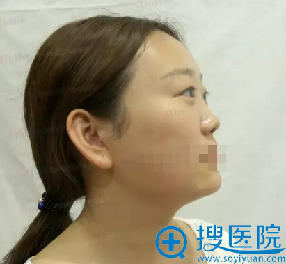 【直播纪实】郑州天后整形医院李小正肋软骨隆鼻手术全过程