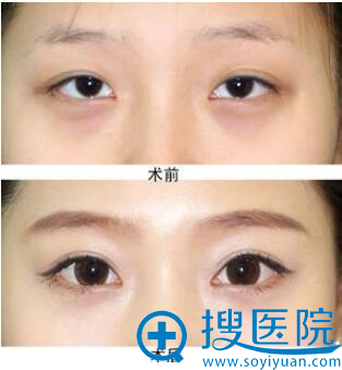 开眼角前后对比图 开眼角前后对比图