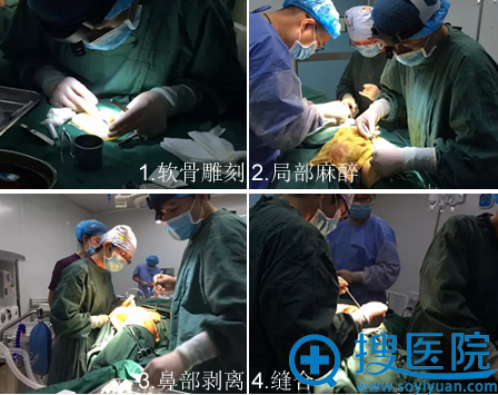 肋肋软骨隆鼻手术过程 肋肋软骨隆鼻手术过程