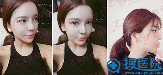 广州艺美李闯鼻综合修复术后恢复效果 广州艺美李闯鼻综合修复术后恢复效果