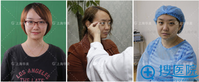 上海华美佀同帅医生割双眼皮实例 大眼睛双眼皮真的怎么都好看