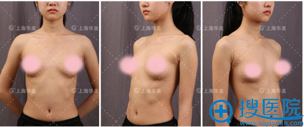 上海华美丰胸怎么样 李健院长隆胸真实案例告诉你效果好到爆
