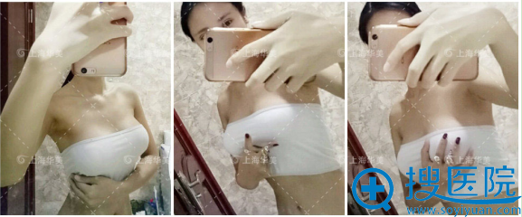 隆胸1个半月了,对胸型超满意 隆胸1个半月了,对胸型超满意