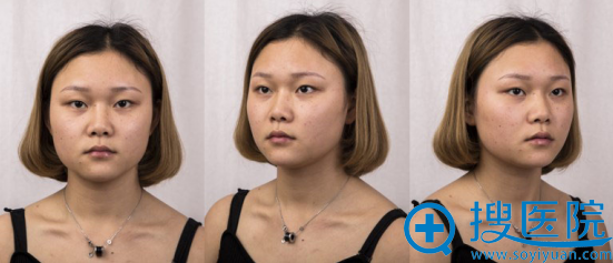 上海华美杨亚益割双眼皮案例 定制park双眼皮术后2个月真实记录