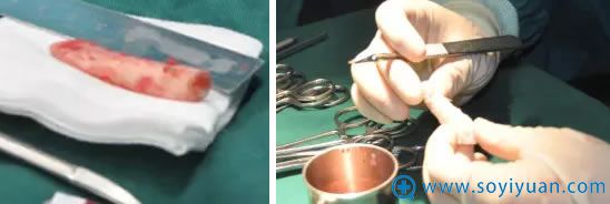 肋骨隆鼻手术之肋骨雕刻过程 肋骨隆鼻手术之肋骨雕刻过程