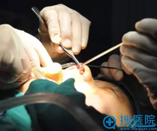 隆鼻手术之腔隙分离过程图 隆鼻手术之腔隙分离过程图